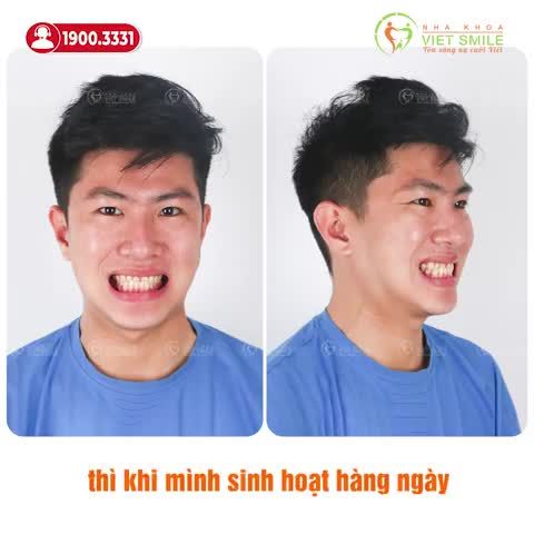 TRẢI NGHIỆM NIỀNG RĂNG MÓM KHÔNG ĐAU, LỘ TRÌNH CHI TIẾT